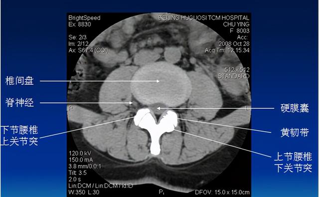 腰椎间盘CT诊断：椎间盘膨出、突出、椎管狭窄及退行性病变