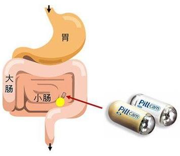 未知病魔折磨多年，一颗胶囊扭转乾坤