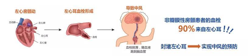 89岁高龄老人心脏里装“保护伞”，从此远离中风