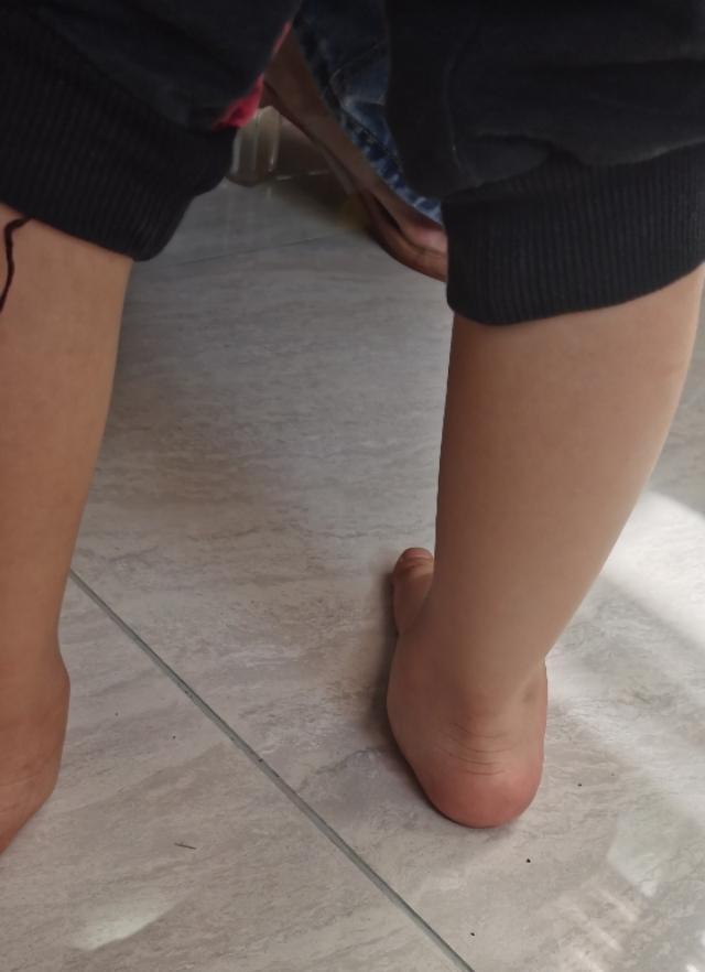 超级宝妈|足外翻需要怎样治疗预防？