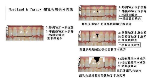 牙齿出现黑三角怎么办？真的是不可逆的吗？听听看牙医怎么说