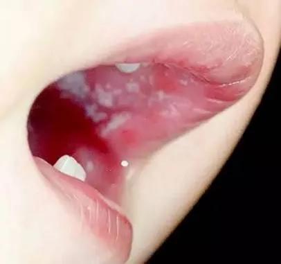 逗比大家庭|疱疹性咽峡炎又到高发期！别与手足口病、口腔溃疡搞混了