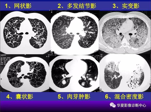 肺间质性疾病的解剖、病理、影像分析