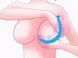 “乳腺增生”怕刮痧，多刮刮就好了