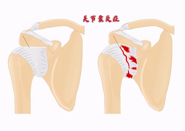 肩周炎最害怕什么？医生从三个方面给您详解，如何对抗冻结肩