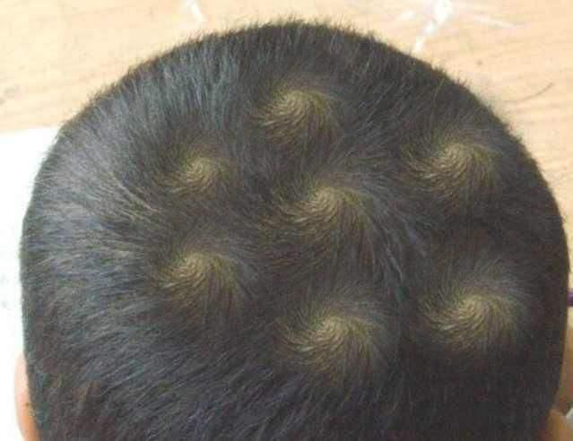 你的育儿经@“二旋拧，三旋打架不要命”孩子头上的旋不是迷信，科学依据是啥