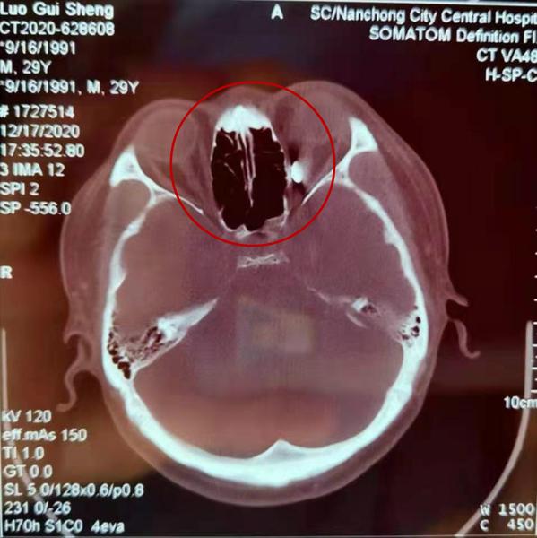 南充市中心医院耳鼻咽喉头颈外科高难度手术成功取出患者眶内异物