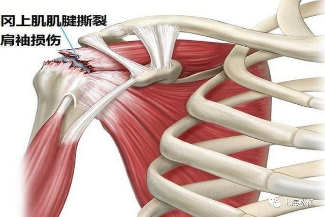 损伤|60% 以上的肩痛都是由它引起的……和平时乘公交、遛狗都有关