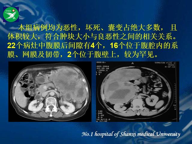 李健丁教授：胃肠道外间质瘤的CT表现和临床病理分析