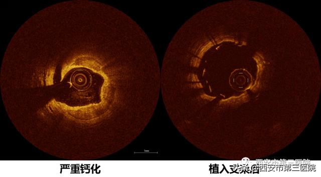 【精准治疗】西安市第三医院心内科首次使用OCT指导冠脉支架植入术