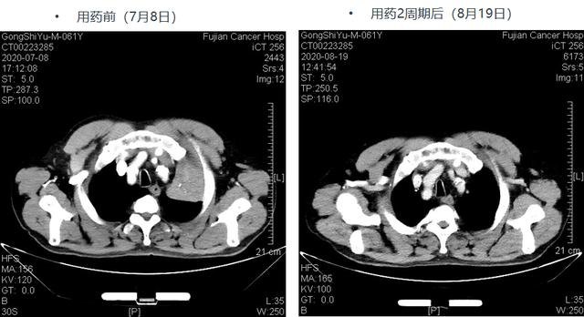 百例之约 | 新辅助免疫联合化疗为中晚期肺鳞癌患者带来惊喜！患者术后实现pCR