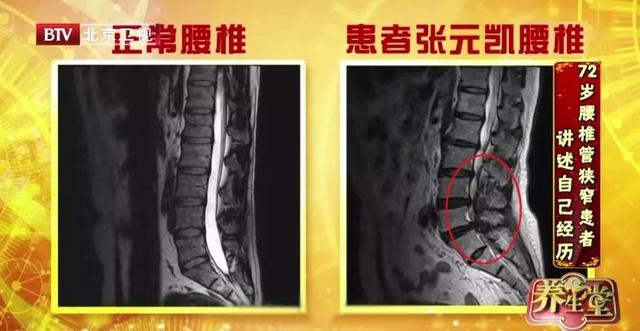 膝关节|天一冷，膝盖就痛？教你2个简单小测试，找出腰腿小毛病