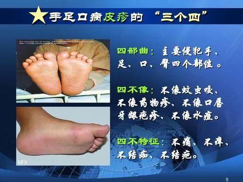 超级宝妈|注意！手足口病进入高发期