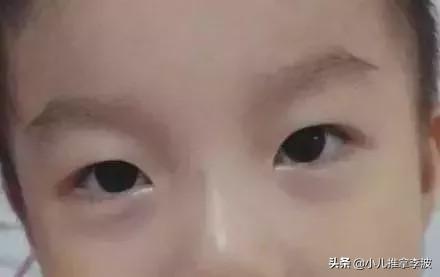 #超级宝妈#小儿推拿李波：孩子脾胃好不好？除了看舌苔眼袋颜色也能帮你判断