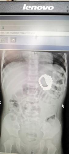 「光明网」将磁力珠当成糖果 2岁女孩吞下了51颗