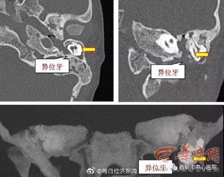 发育|5岁男童耳朵里长了3颗牙齿：胎儿期发育紊乱所致
