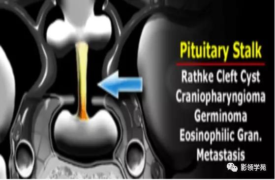 垂体病变的MRI诊断