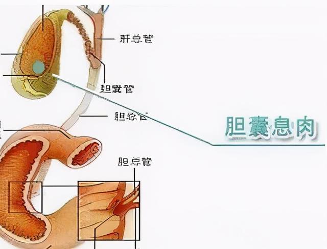 胆囊息肉患者在日常生活中不能够吃什么呢？