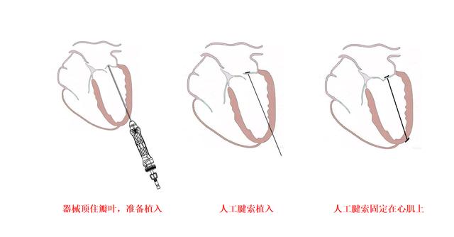 手术|亚洲首例！中山医院完成穿刺式二尖瓣腱索重建手术，患者术后3天即出院