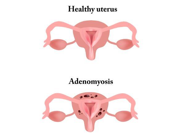 女性腰疼无法改善，除了腰部问题，警惕背后是这4种妇科病在捣乱