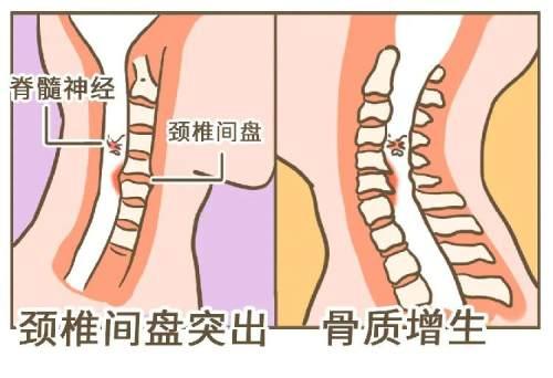 落枕可能是身体的「求救信号」，别不当回事