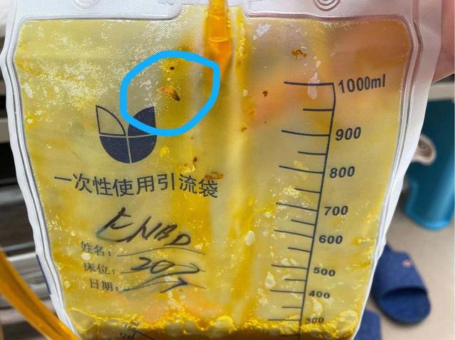宋先生|男子爱吃生江鱼片，结果胆中取出10条虫子