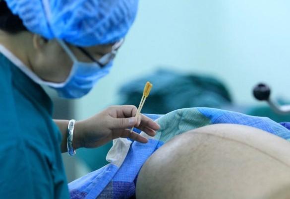 超级宝妈|媳妇儿剖腹产，婆婆坚持让她卧床，医生喊话：想不想恢复的好？