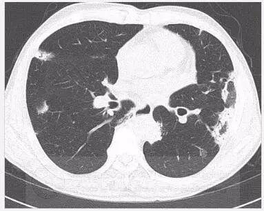 患者无特异性症状，双肺斑片状实变的原因是？丨以影识病