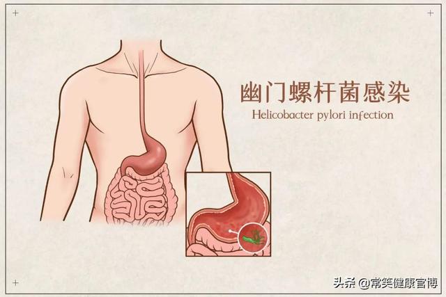 Hp治疗再添一员猛将，调节肠道菌群，还是得要益生菌来