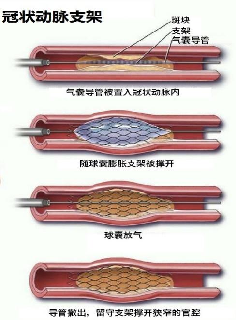 支架|心内科梁春教授：3种冠状动脉支架有哪些你