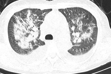 「典型」的肺水肿，为何用抗生素狂轰滥炸？