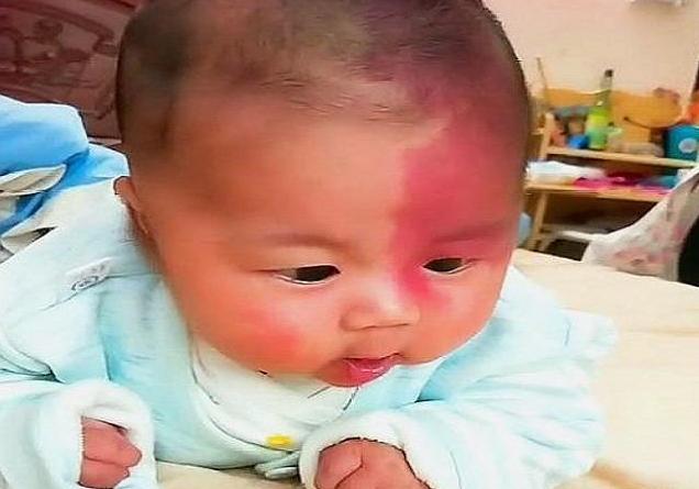 你的育儿经|胎记是怎么回事？产科医生：除遗传，怀孕时这3种行为注意避开