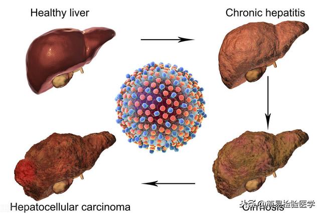 小心肝，肝纤维化离你并不远（肝纤维化检测完整版）
