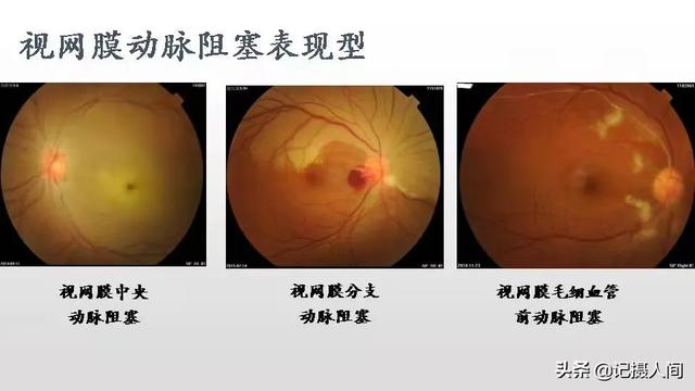 西安程序员一周熬夜5天竟患上......医生：发病率为十万分之二