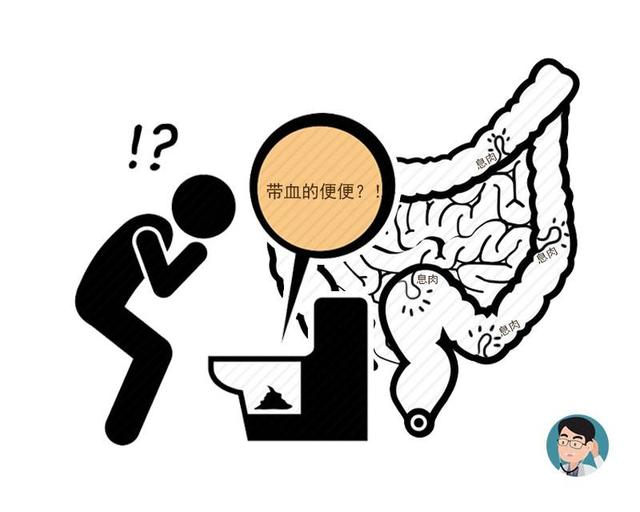 以屎为镜，可知肠道健康？排便出现这4种异样，劝你及时做肠镜