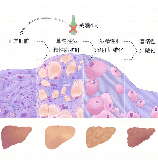 酒精进入体内后，吃什么“解药”能快速醒酒？答案终于明确了