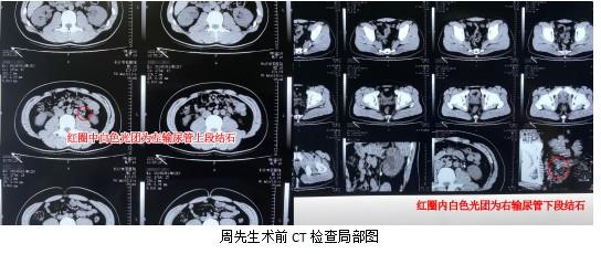 结石|男子每天把饮料当水喝，结果身体出现惊人变化