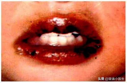 超级宝妈|跟“儿童怪病”很像的川崎病，你认识么？