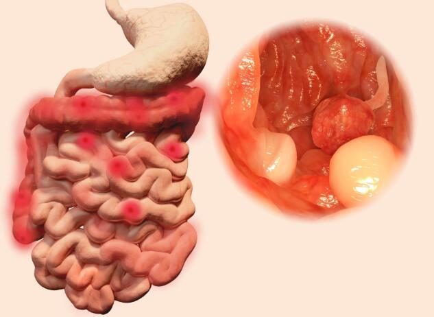 大肠癌和痔疮有差异，出现这5个特点，很可能是肠癌的症状