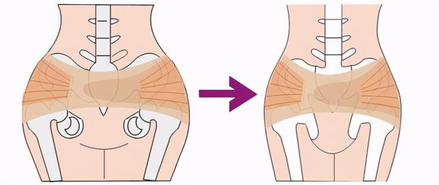 生娃后变胖，胯骨变宽？骨盆没聚合才是根本原因