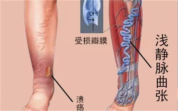 下肢|“小蚯蚓”引发“大猝死”！久坐族，静脉曲张没你想那样简单