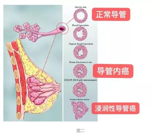 乳腺癌到底从哪里来