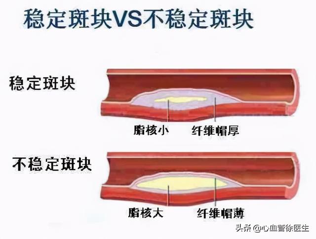 冠心病患者为何要长期吃阿司匹林和他汀降脂药？有哪些注意事项？