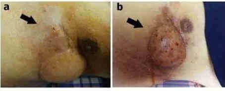 肉瘤|SNH女团成员刘丽千直播时吐血，竟是这种恶性肿瘤