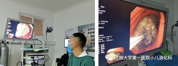 「你的育儿经」长春五岁女童自己揪这个吃，胃里巨大胃石，元凶就是它