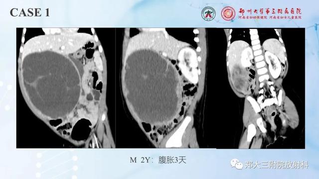 儿童腹部囊性病变诊断思路分析