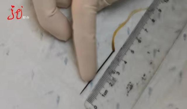 大庆一男子肚里藏了一根针，一半在胃里，一半在胃外！针孔上还有一根线