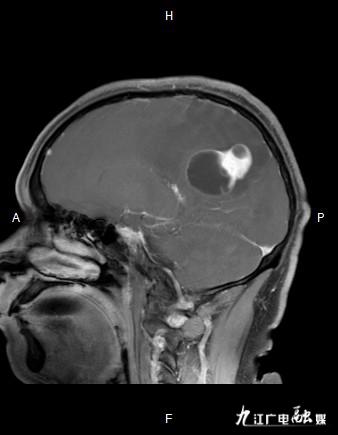 生命活水医疗集团总院神经外科MDT模式下成功诊治1例颅内血管周细胞瘤