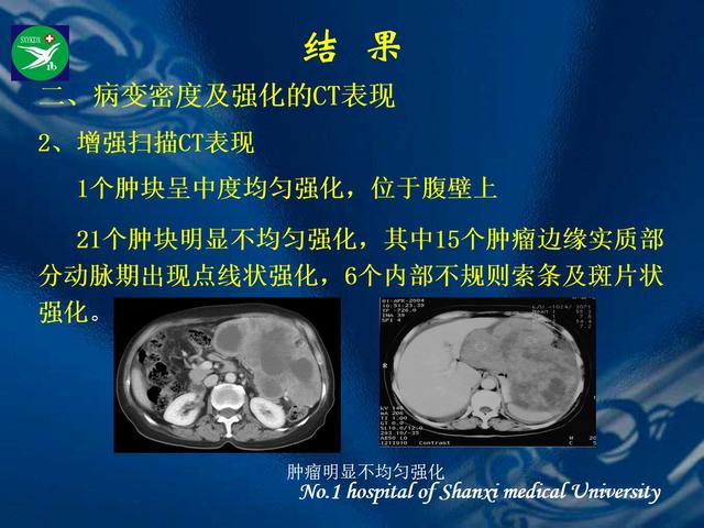 李健丁教授：胃肠道外间质瘤的CT表现和临床病理分析