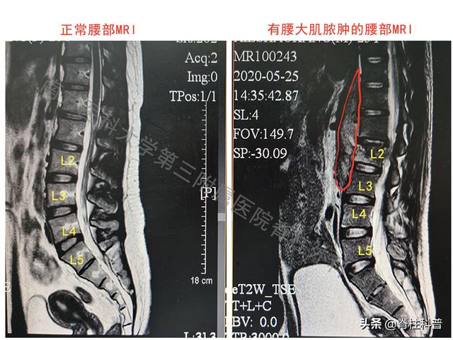 24岁男孩7年1型糖尿病病史又合并了腰大肌脓肿该如何是好？